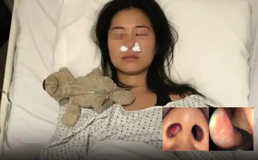 She grew a cluster of fungi in her nose — all because of a habit nearly everyone does daily…