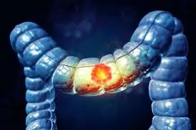 Study finds possible cause of unexplained colon cancer rise in young people