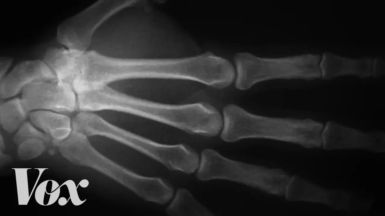 Unsettling Simulation Reveals What Really Happens When You Crack Your Knuckles