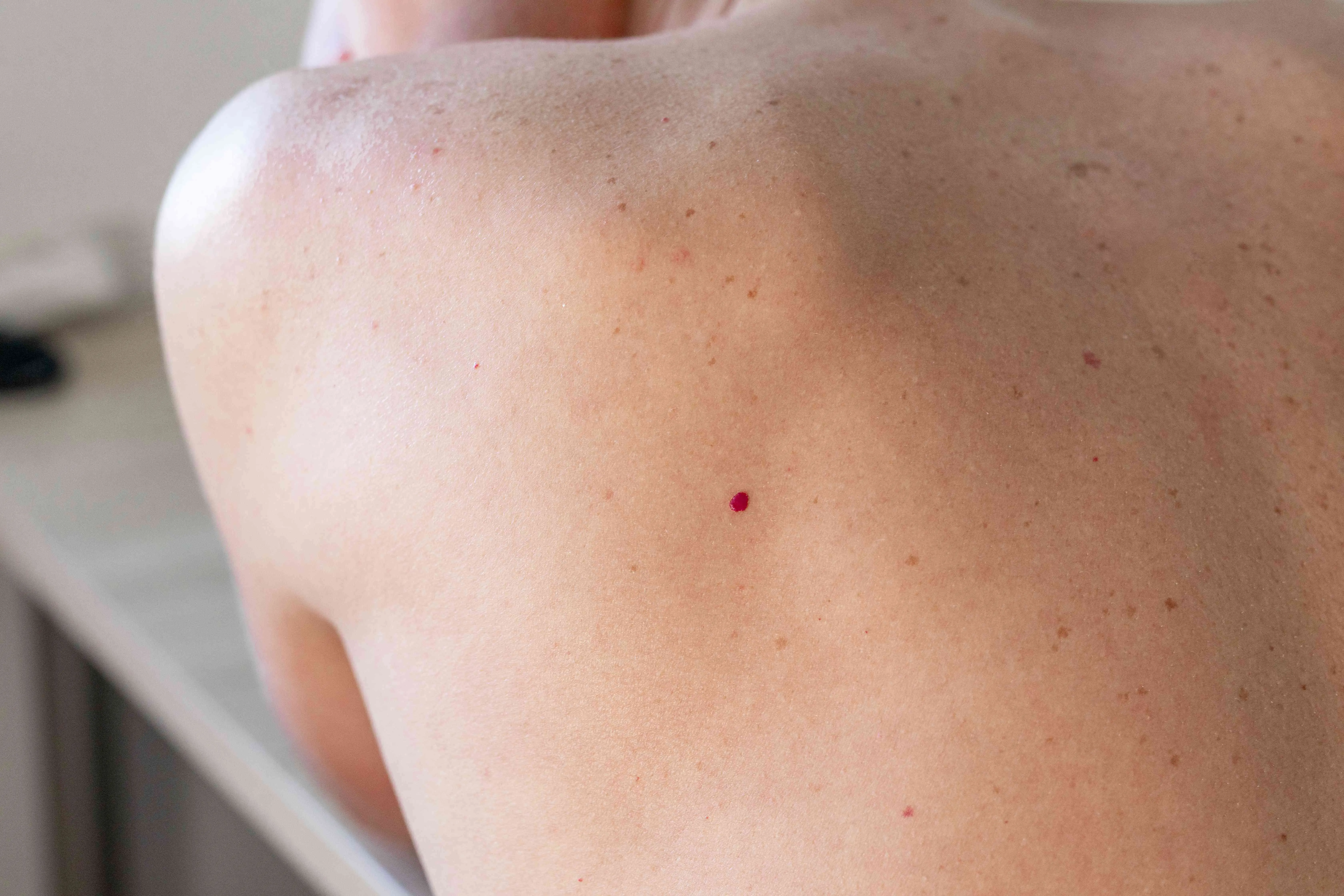 If You Notice These Red Dots on Your Skin, Here’s What They Might Mean