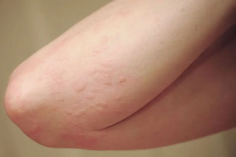 What’s Causing Your Hives? Hidden Triggers You Might Not Expect