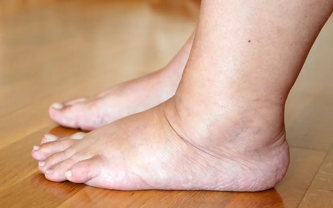 Your feet might be warning you: 10 symptoms linked to dia.betes