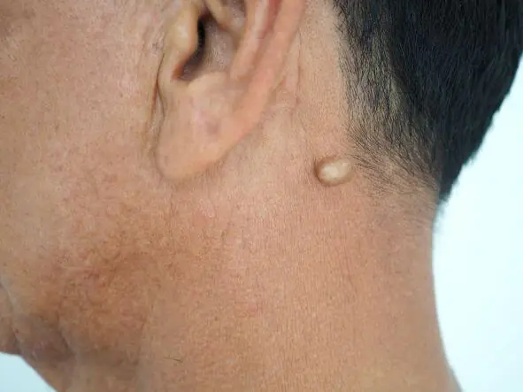 Possible causes of a lump on the back of the neck hairline