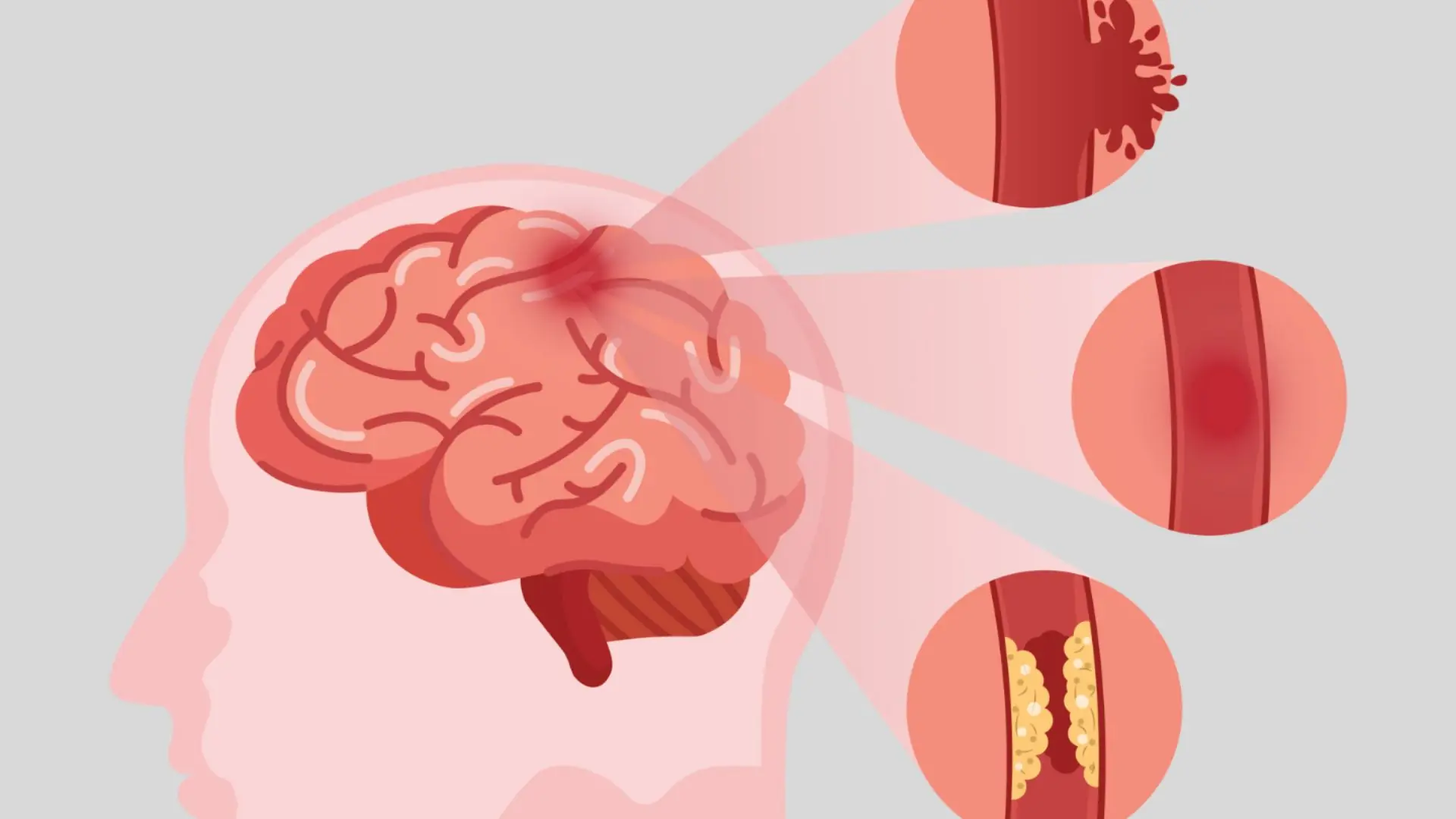 Cerebral Ischemia Can Lead to These 5 Dan.gerous Complications - Here’s How to Stay Safe