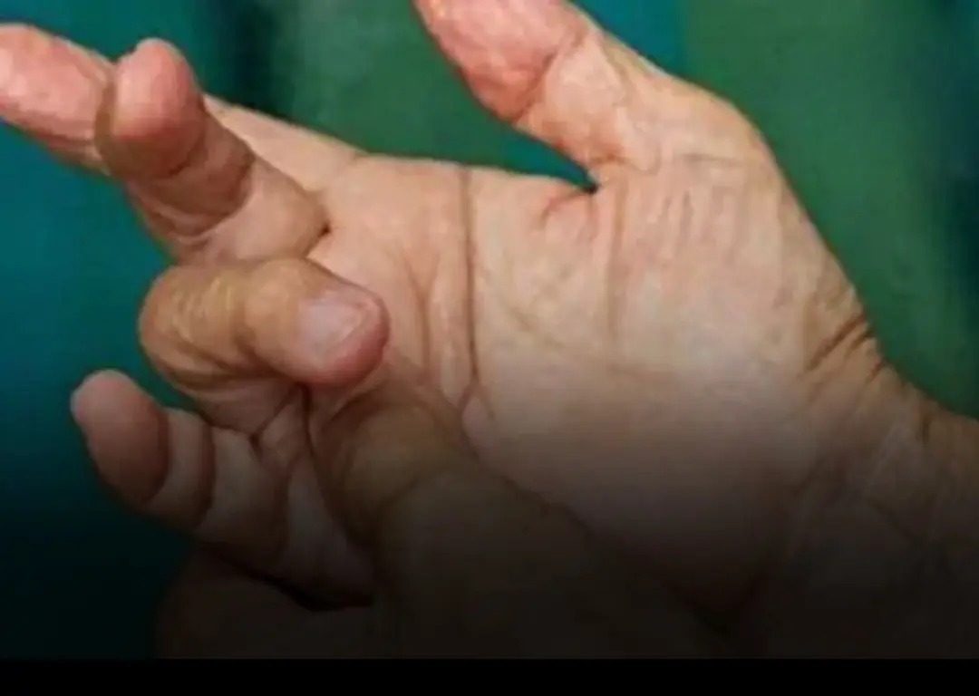 4 changes in fingers that could be signs of lung can.cer