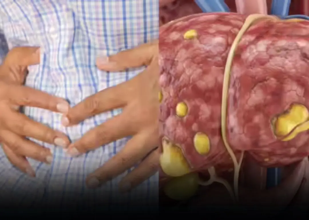 Fatty Li.ver in Women: 6 Hidden Symptoms That Often Go Unnoticed