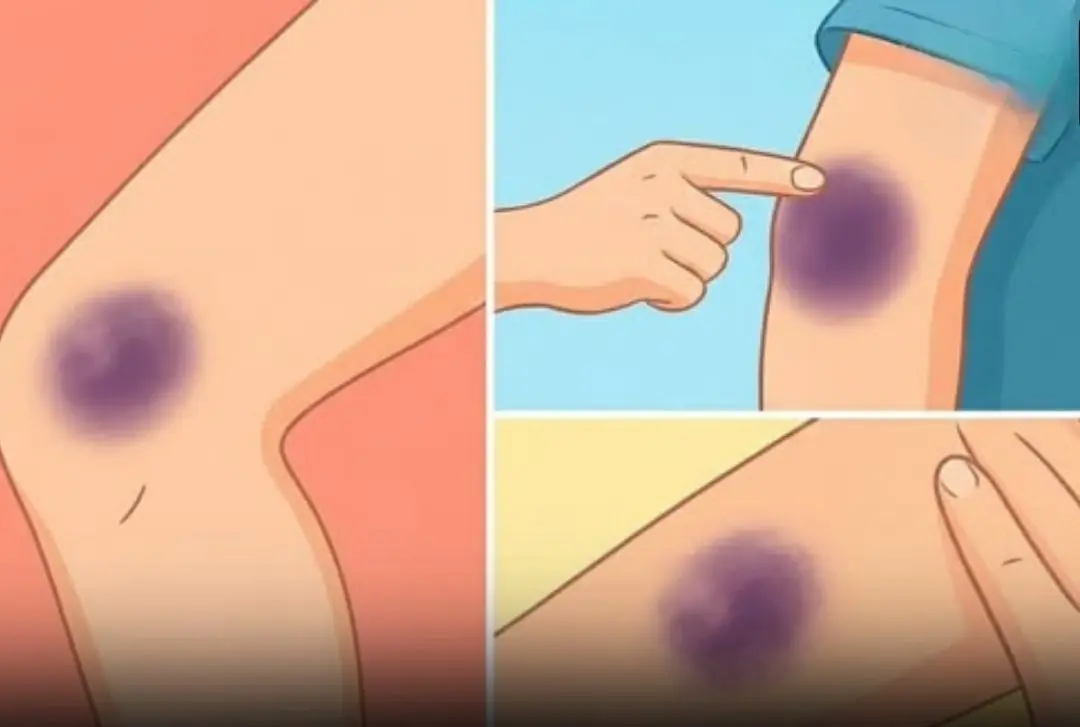 These Unusual Bruises on Your Body Could Be Trying to Tell You Something
