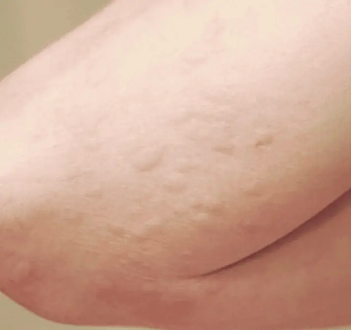 His whole body was itching—he thought it was just an allergy, but doctors later diagnosed…