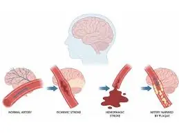 Silent Strokes Can Occur Without Warning — Here Are Small Habits That Could Protect You