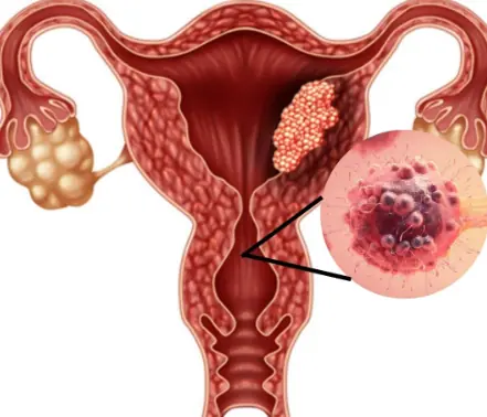 Don’t Miss These 5 Warning Signs of Cervical Cancer