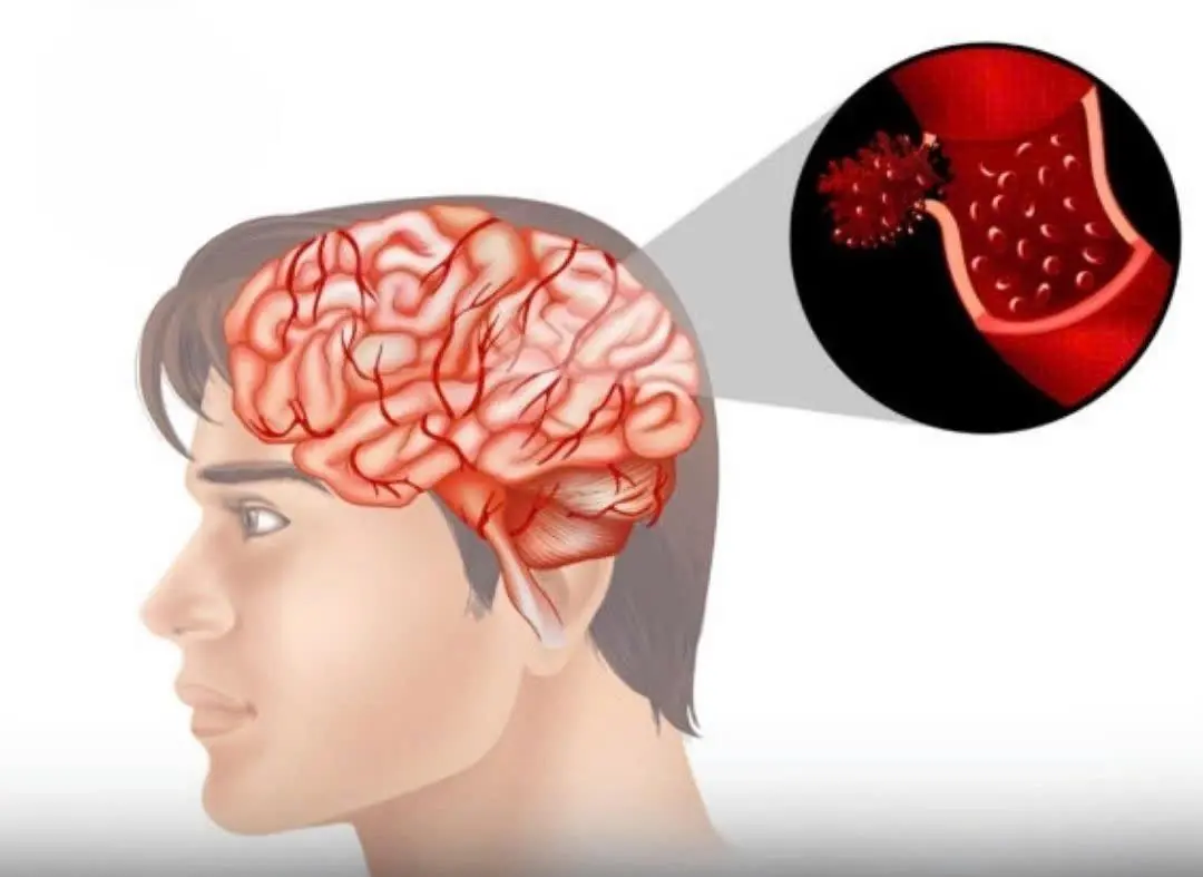 4 Morning Mistakes That Increase Str.oke Ris.k — No Matter Your Age