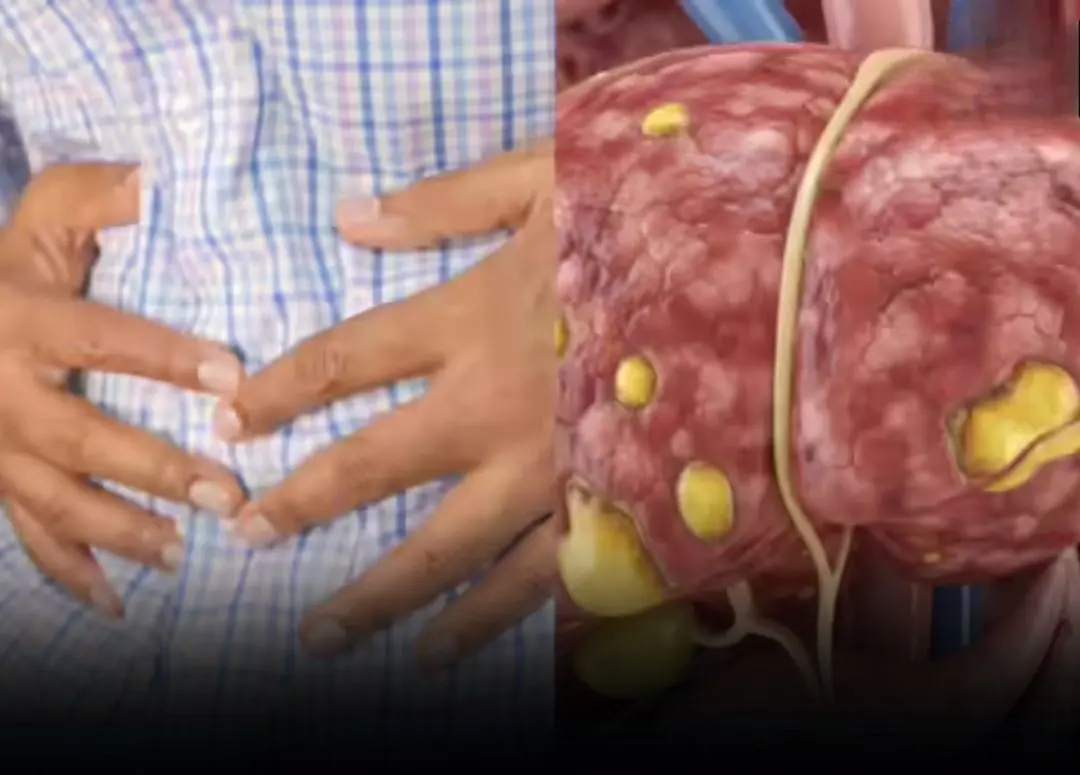 Fatty Liver in Women: 6 Hidden Symptoms That Often Go Unnoticed