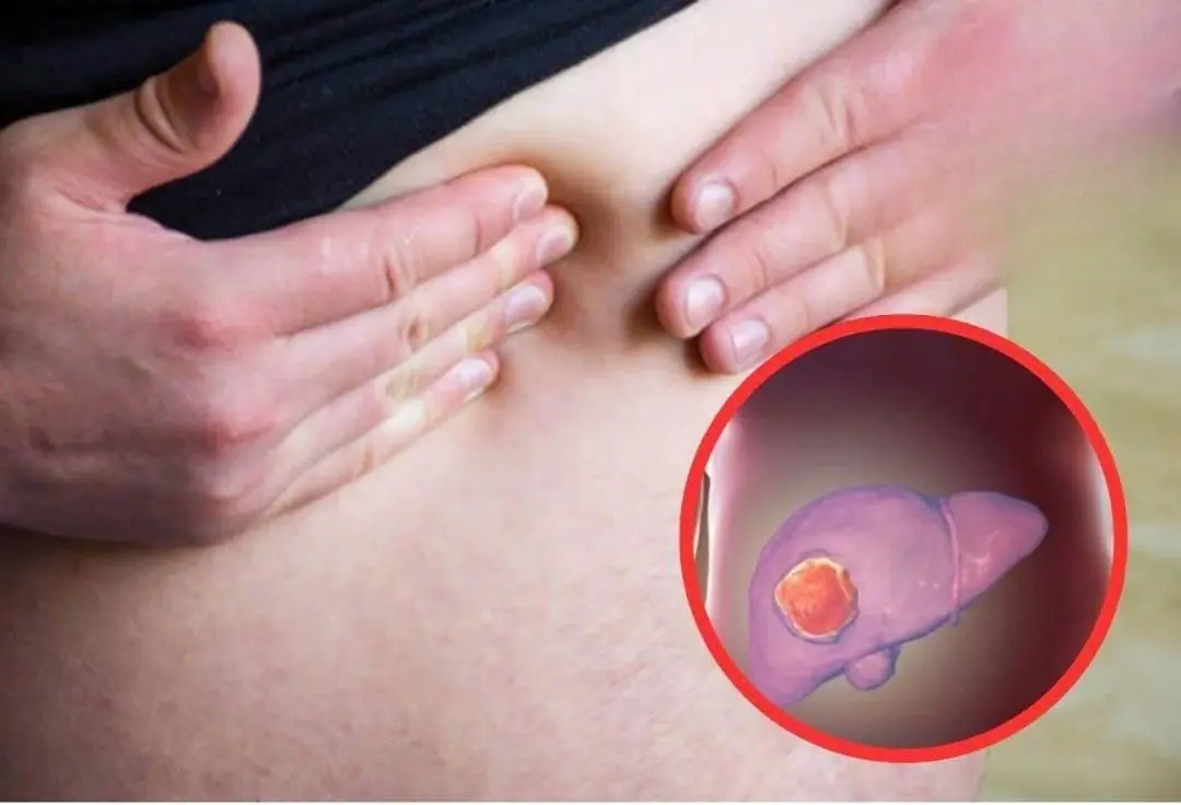 A protruding belly might not simply be the result of excess fat—it could signal liv.er dise.ase, including liver can.cer