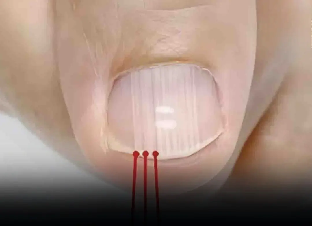 If You Have These Lines on Your Nails After 40… Here’s What They Really Mean