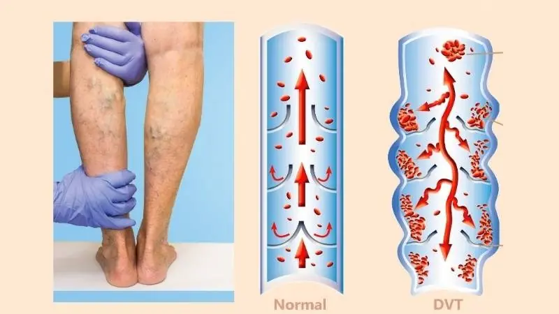 6 Easy Things to Improve Circulation and Relieve Cold Feet or Varicose Veins