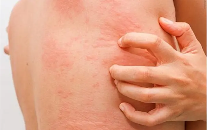 Risk of Adrenal Insufficiency from Misusing Unknown Painkil.lers: A Warning Many People Overlook