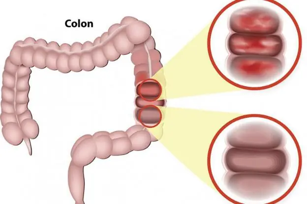 6 Early Clues Your Body Might Be Showing About Stage 1 Colon Cancer