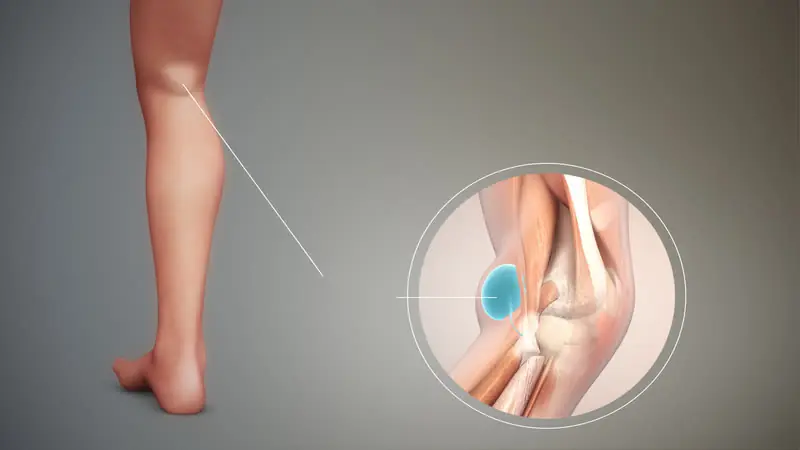 Muscle Pain Behind the Knee Could Signal Something Serious