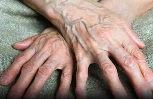 Bulging Veins Are a Red Flag: What You Should Urgently Tell Them