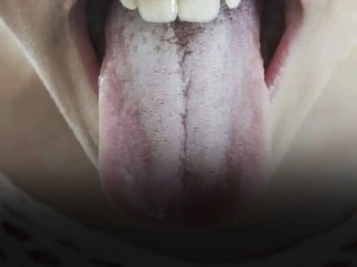If your tongue is white, this is a clear sign that you are suffering from…see more