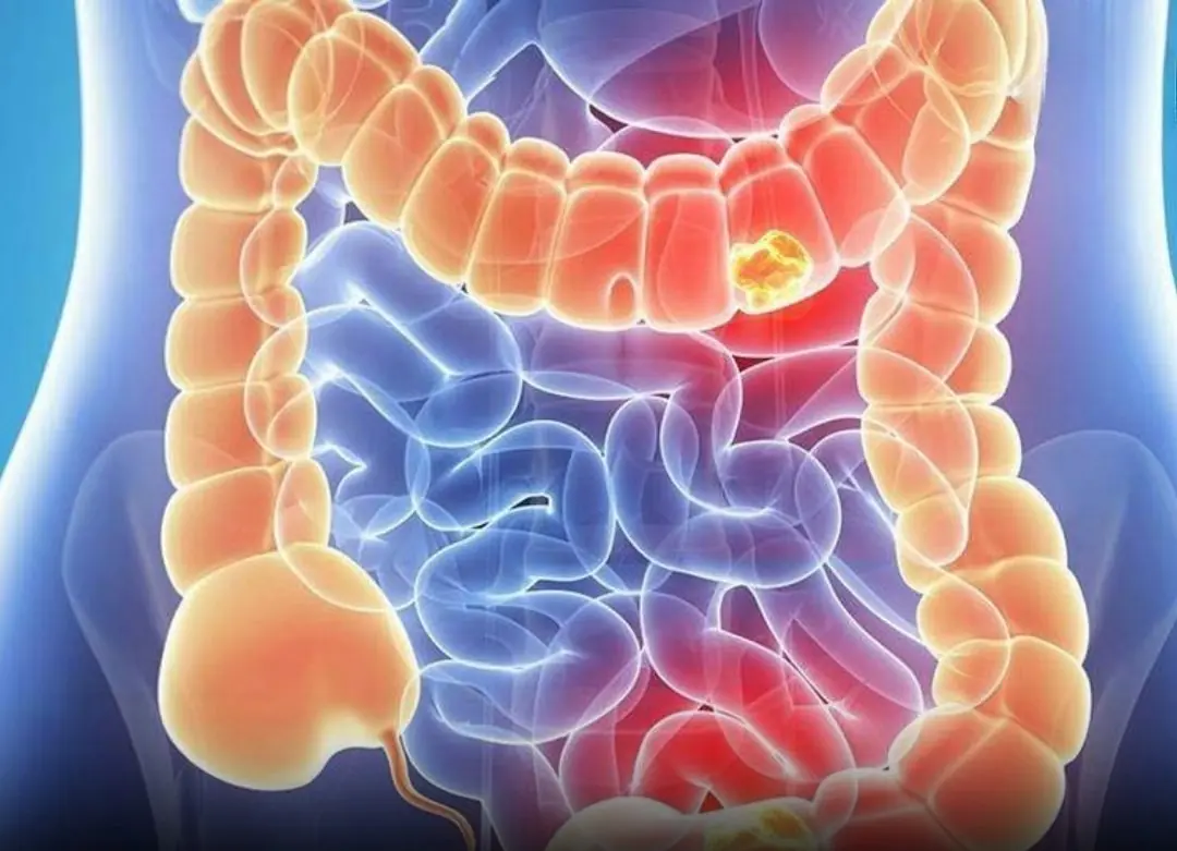 Stage Four Colon Can:cer: A Woman Shares 5 Early Warning Signs She Overlooked
