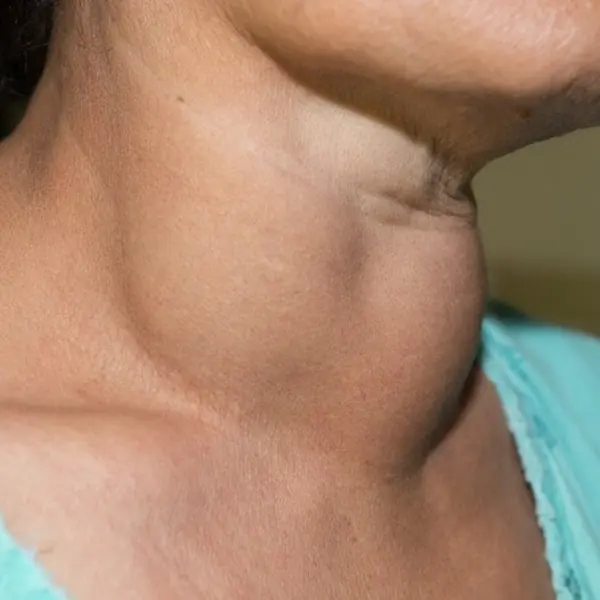 Thyroid Can.cer Warning: 7 Early Body Changes You Should Never Ignore
