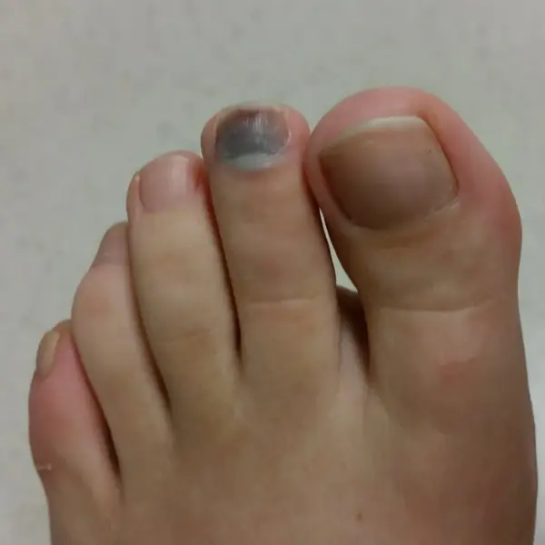 Why Your Toenail Turns Black—and What You Should Do About It
