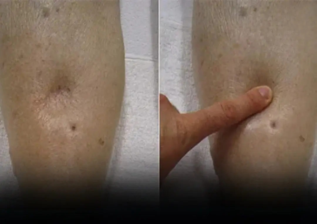 8 Important Signs of Early - Stage Kidney Disease