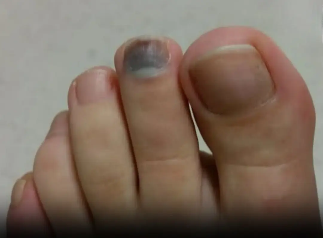 Black Toenail? Here’s What It Means — and How to Fix It