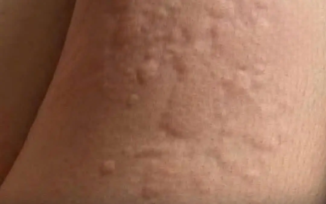 What he thought was a simple allergy turned out to be something far more alarming