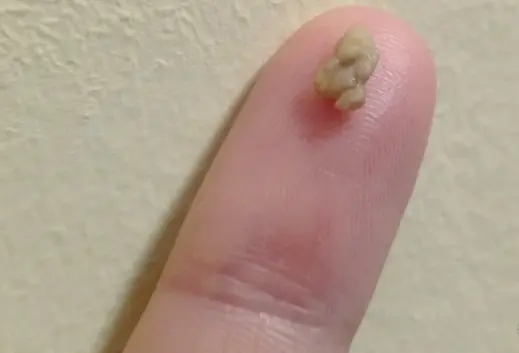 You suddenly feel something lodged in your throat, and then a small lump comes out - what could it be?