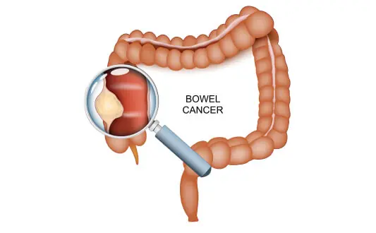 Stage 1 Colon Cancer: 6 Early Symptoms You Should Never Overlook