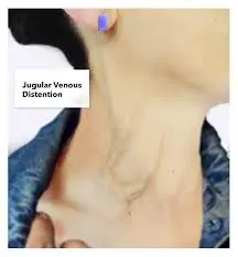 When the Jugular Vein Bulges: Warning Signs You Must Recognize