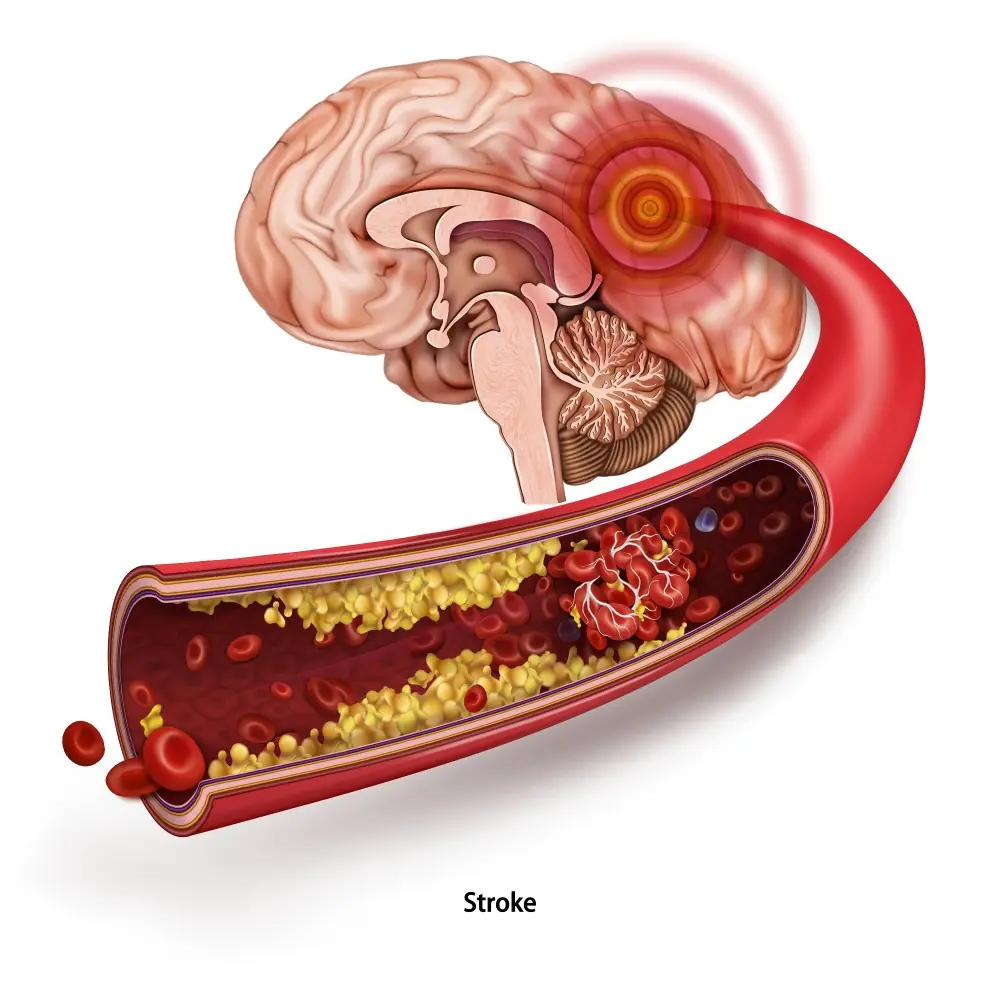 6 powerful ways to maintain healthy, unclogged arteries