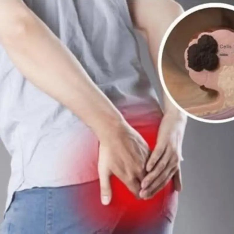 Colon Can.cer Is Increasing: 5 Symptoms You Should Be Aware Of