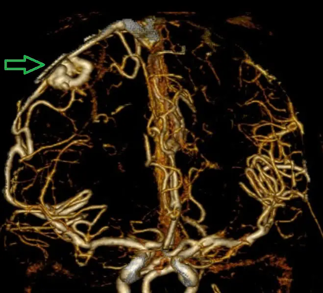 Doctors Warn of a “Hidden Time Bo.mb” in the Brain: Many Young People Overlook This Warning Sign