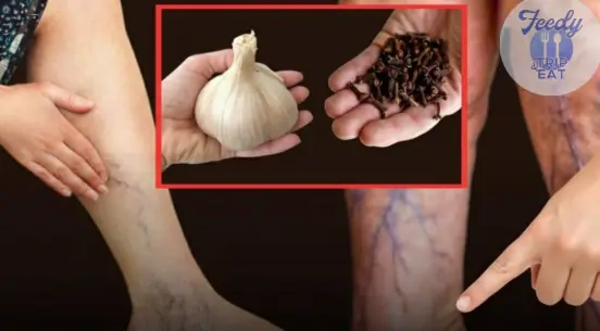This Clove & Garlic Remedy Could Help Ease Leg Pain Naturally