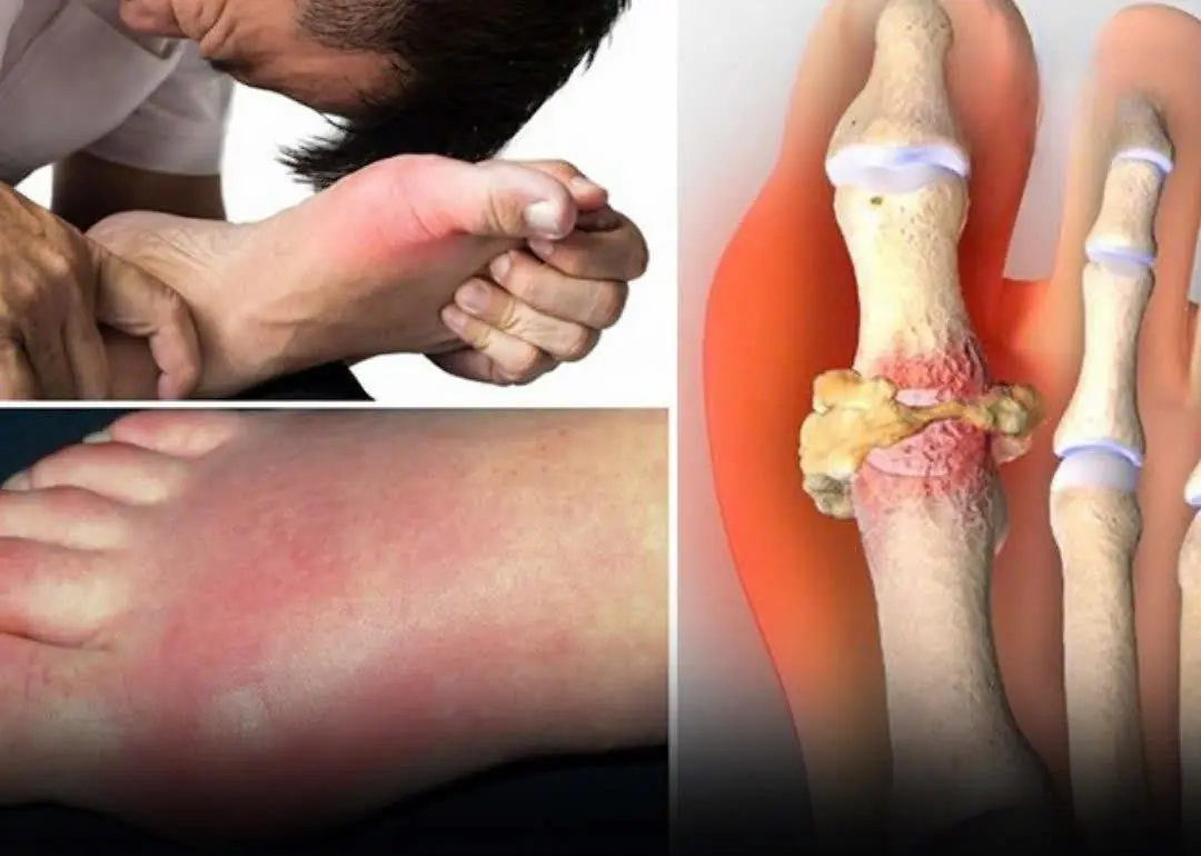 Gout is becoming increasingly common, and if you have it, certain foods should be strictly
