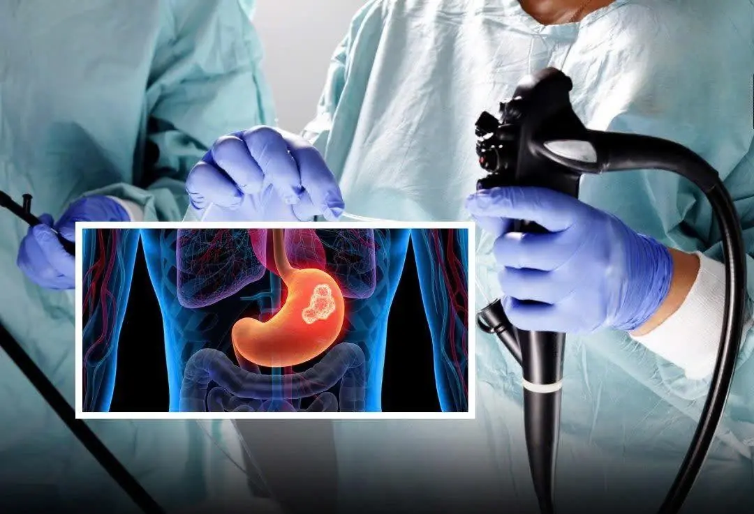 Most cases of stomach can:cer are detected too late. Watch for these 5 after