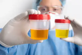 Urine Changes You Should Never Ignore—Could Be Kidney Failure