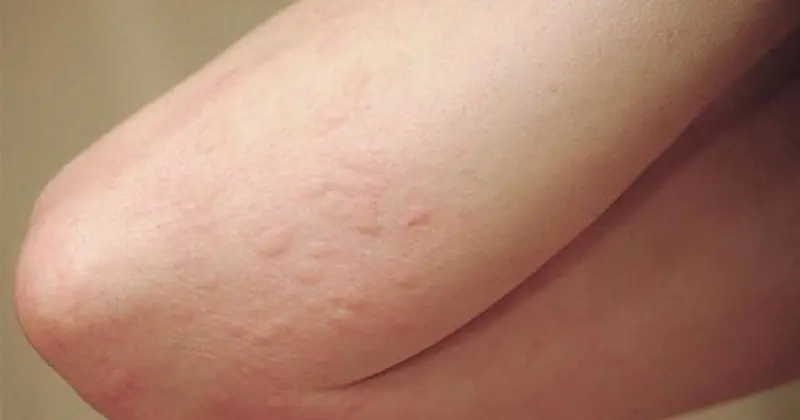 This Man’s Persistent Itching Turned Out to Be Something Serious