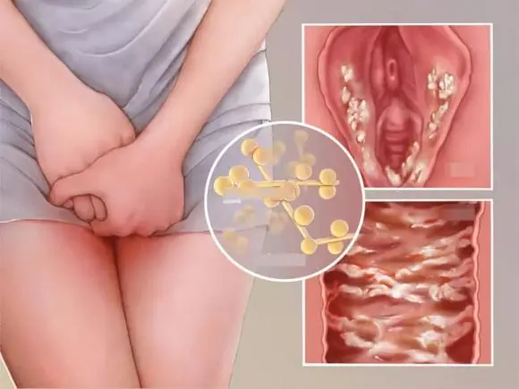 Women with Gynec.ological Infections Are Advised to Change These Common Habits