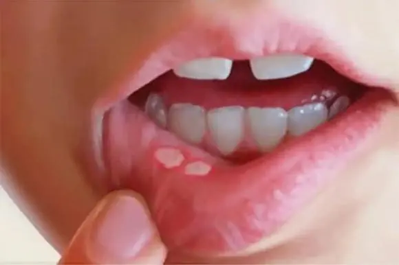 Doctors Warn: The Most Dangerous Sign of Diabetes Isn’t Thirst or Frequent Urination—But These 5 Overlooked Symptoms