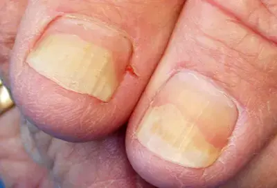 See These 3 Marks on Your Nails? Don’t Ignore Them—Visit a Doctor Now