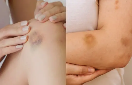 Unexplained Bruises? Here’s What Your Body Might Be Telling You
