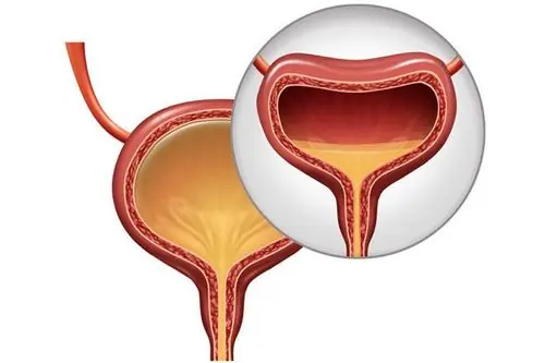 Early Clues of Bladder Cancer That Are Easy to Overlook