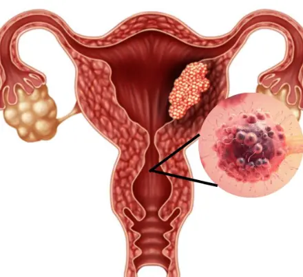 5 Silent Symptoms of Cervical Cancer Every Woman Should Know