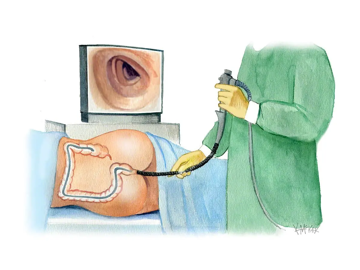 Colonoscopy preparation: The one question you shouldn’t forget to ask your doctor