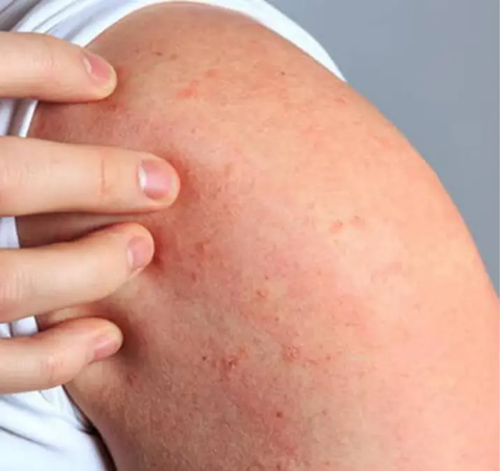 His Whole Body Was Itchy—He Thought It Was an Allergy, But the Diagnosis Changed Everything