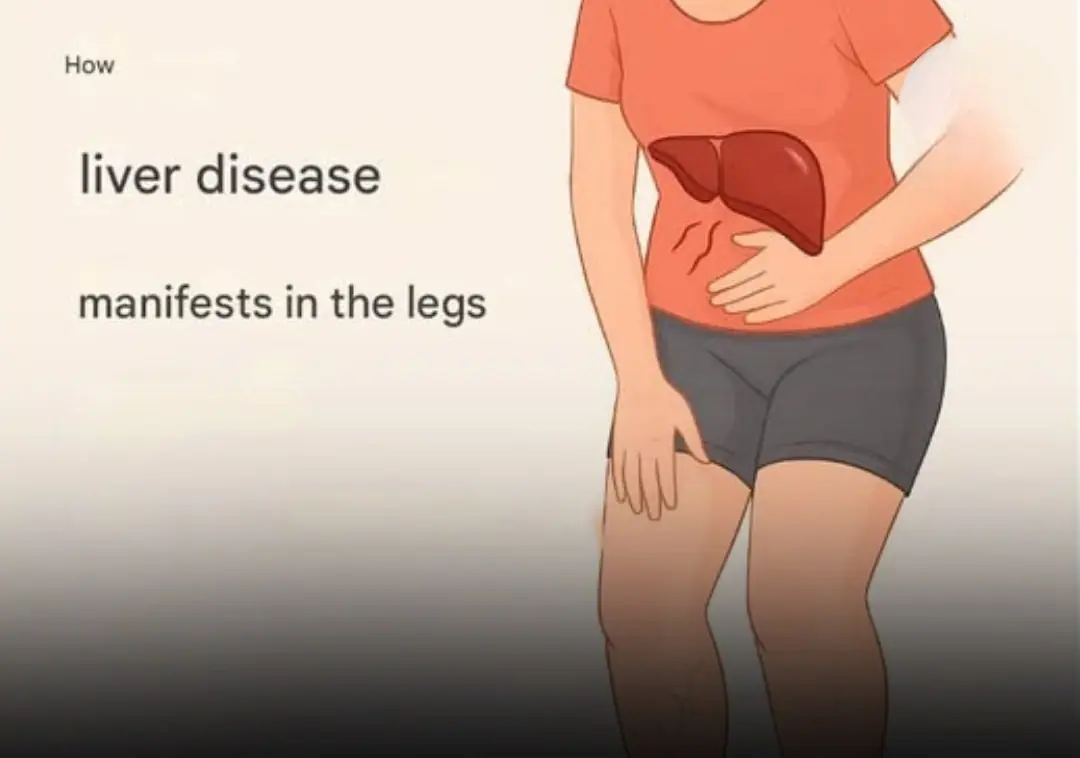 The Surprising Ways Liver Disease Appears on the Legs